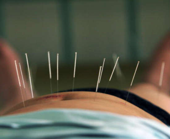 O acupunturista é responsável pela aplicação e manejo de agulhas no corpo do paciente, como forma de tratar dores e problemas de saúde localizados  Foto: Getty Images