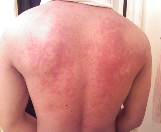 2º lugar - Alergia de pele.