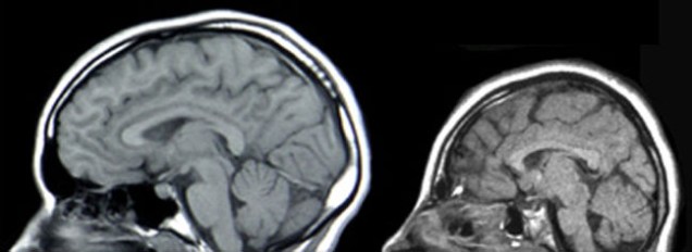 A microcefalia é uma condição neurológica que leva a um déficit no crescimento do cérebro durante a gestação. Em 90% dos casos, ela pode causar distúrbios neurológicos como a epilepsia, problemas de visão e de audição e até retardo mental. A imagem mostra duas tomografias da cabeça lado a lado - a da esquerda é considerada normal e a esquerda é de um paciente com microcefalia. (Imagem: Wikimedia Commons)