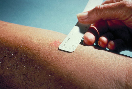 Transmitida pelo Mycobacterium tuberculosis, o bacilo de Koch, a Tuberculose é uma das doenças infecto-contagiosa que mais matam no Brasil. Estima-se que cerca 30% da população mundial esteja infectada, embora nem sempre a doença se desenvolva. A transmissão ocorre por gotículas eliminadas pela respiraçã, espirros e tosse. Os principais sintomas são tosse por mais de duas semanas, produção de catarro, febre, sudorese, cansaço, dor no peito, falta de apetite e emagrecimento. (Foto: Creative Commons) Transmitida pelo Mycobacterium tuberculosis, o bacilo de Koch, a Tuberculose é uma das doenças infecto-contagiosa que mais matam no Brasil. Estima-se que cerca 30% da população mundial esteja infectada, embora nem sempre a doença se desenvolva. A transmissão ocorre por gotículas eliminadas pela respiraçã, espirros e tosse. Os principais sintomas são tosse por mais de duas semanas, produção de catarro, febre, sudorese, cansaço, dor no peito, falta de apetite e emagrecimento. (Foto: Creative Commons)